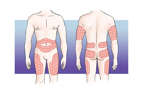 Zonas de inyección Zonas de inyección: parte superior brazos, parte anterior y lateral muslos, parte superior nalgas y abdomen